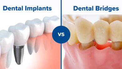 dental-implants-vs.-bridges-in-georgetown:-what's-the-difference?