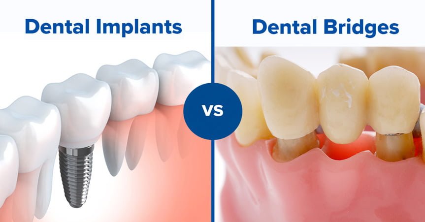 dental-implants-vs.-bridges-in-georgetown:-what's-the-difference?