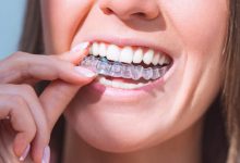 how-do-clear-aligners-work-to-straighten-teeth?