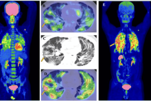 fapi-pet-imaging:-advancing-molecular-imaging-in-oncology-and-fibrotic-diseases.