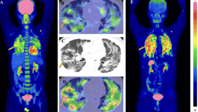 fapi-pet-imaging:-advancing-molecular-imaging-in-oncology-and-fibrotic-diseases.