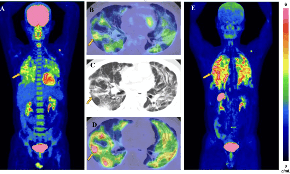 fapi-pet-imaging:-advancing-molecular-imaging-in-oncology-and-fibrotic-diseases.